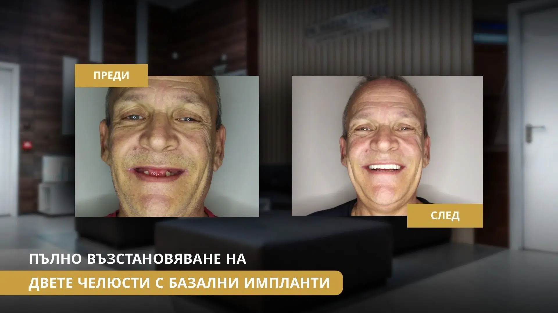 Пациент с периимплантит преди лечение с базални импланти